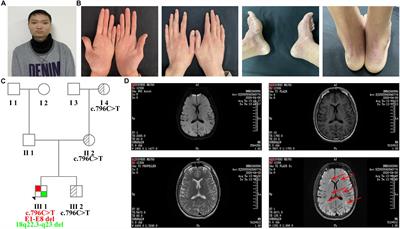 Identification of a Rare Case With Nagashima-Type Palmoplantar Keratoderma and 18q Deletion Syndrome via Exome Sequencing and Low-Coverage Whole-Genome Sequencing